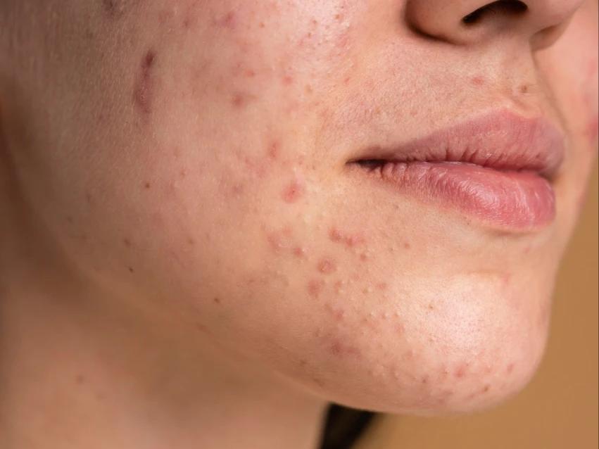 Total & Free Androgens